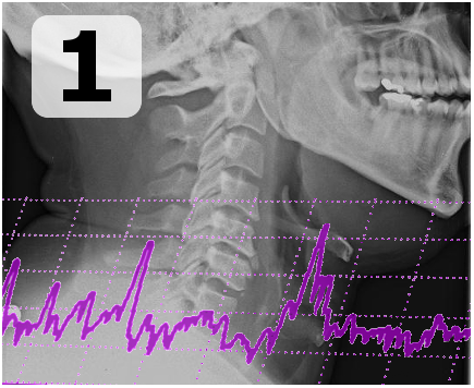 APPLICAZIONE DI sEMG BIOFEEDBACK PER IL TRATTAMENTO DELLA DISFAG